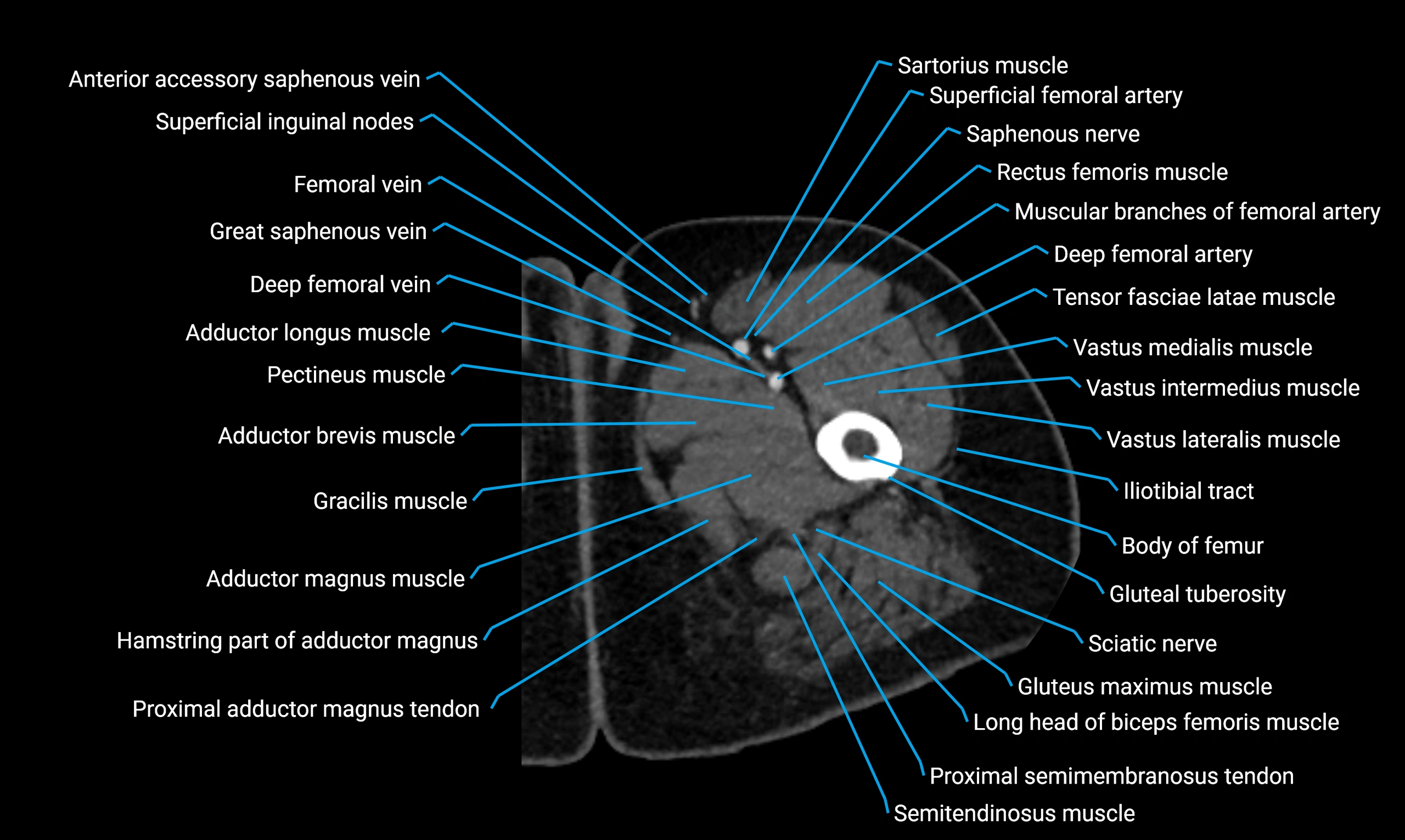 CT thigh axial cross sectional anatomy labelled image_23 (2).webp